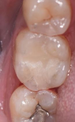 Tooth-colored Fillings Case 21 - After