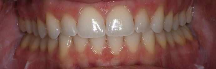 Invisalign Case 8 - Nursery, TX - After