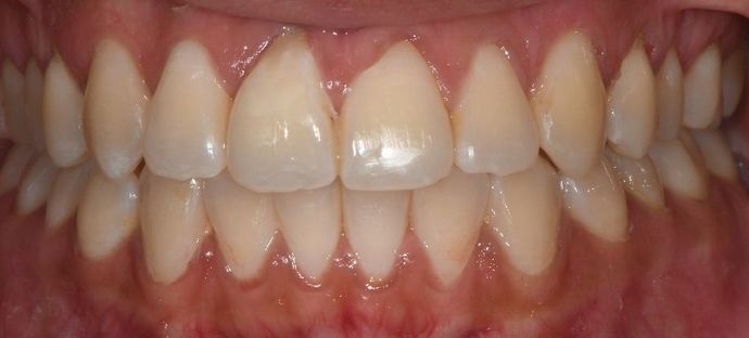 Invisalign: Case 10 - Victoria, TX