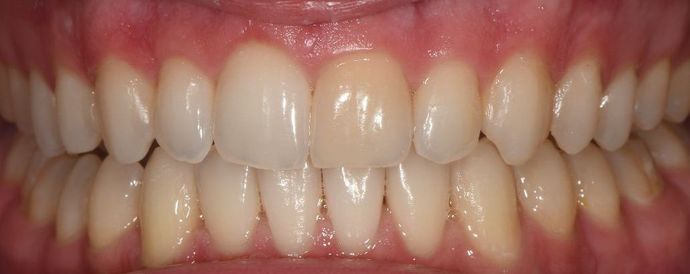 Invisalign: Case 11 - Yorktown, Tx