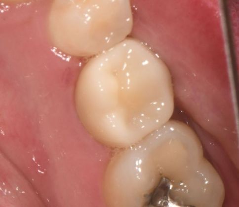 Crowns Case 17 - Cuero, TX - After