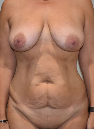 Massive Weight Loss : Case 80 - Before