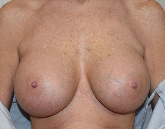 Breast Revision: Case 169 - After