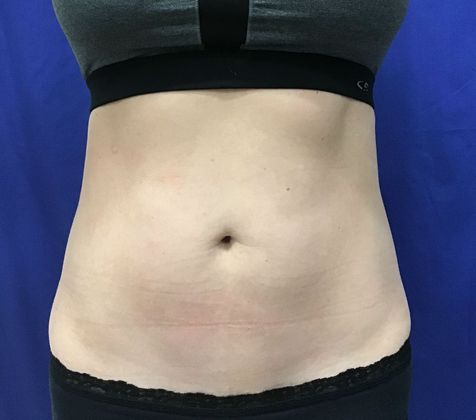 Body Coolsculpting: Case 6 (18373) - After.  Little muscle definition change.