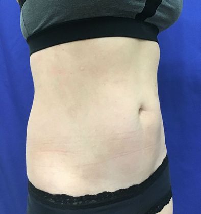 Body Coolsculpting: Case 6 (18373) - After.  Better tone.
