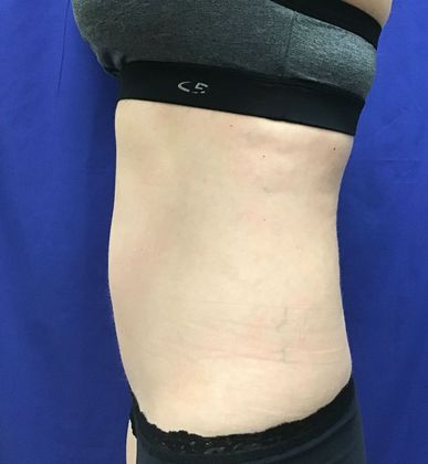 Body Coolsculpting Case 6 (18373) - After