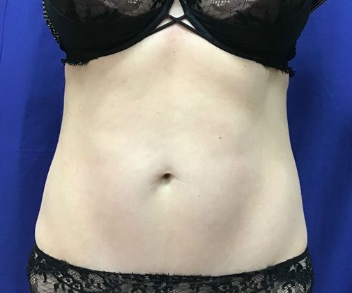 Cooltone Muscle Stimulation: Case 5 (18373) - Before