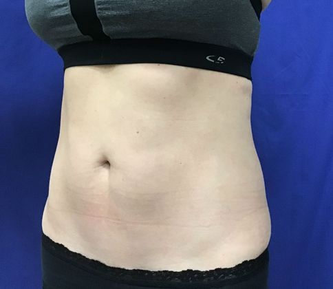 Cooltone Muscle Stimulation: Case 5 (18373) - After