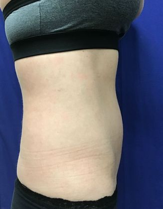 Cooltone Muscle Stimulation: Case 5 (18373) - After. Better contour.