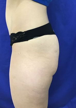 Cooltone Muscle Stimulation: Case 1 (18990) - Before