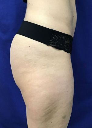 Cooltone Muscle Stimulation: Case 1 (18990) - Before