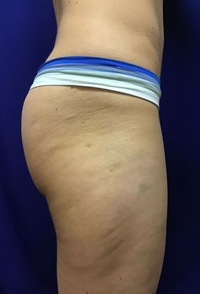 Cooltone Muscle Stimulation: Case 1 (18990) - After