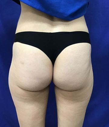 Cooltone Muscle Stimulation: Case 1 (18990) - Before