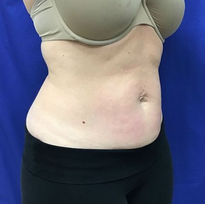 Body Coolsculpting: Case 7 (31213) - After