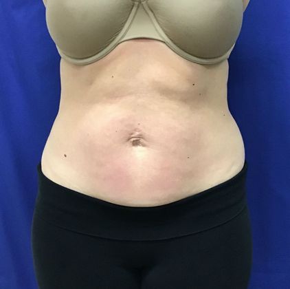 Body Coolsculpting Case 7 (31213) - After