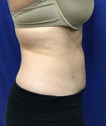 Body Coolsculpting: Case 7 (31213) - After
