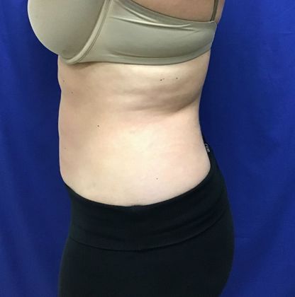 Body Coolsculpting: Case 7 (31213) - After