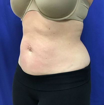 Body Coolsculpting: Case 7 (31213) - After