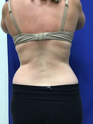 Body Coolsculpting: Case 7 (31213) - After
