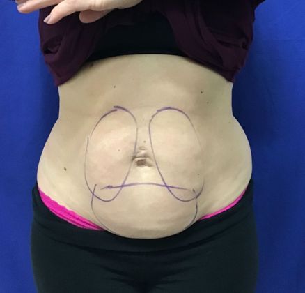Body Coolsculpting Case 7 (31213) - Before