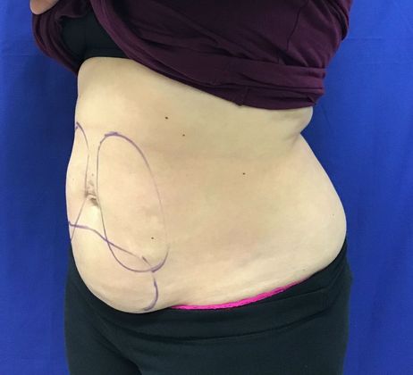 Body Coolsculpting: Case 7 (31213) - Before