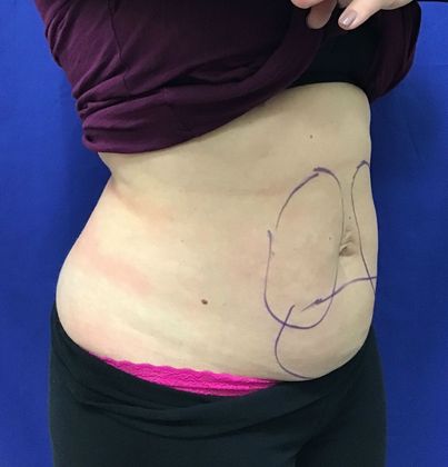Body Coolsculpting: Case 7 (31213) - Before