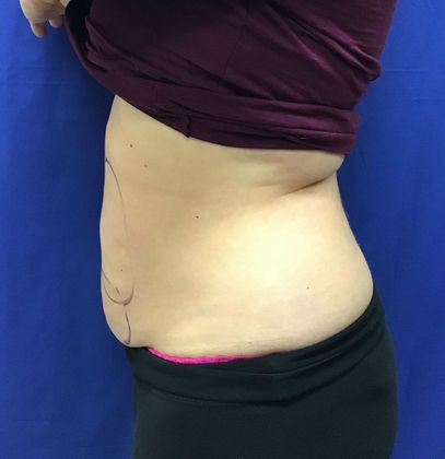 Body Coolsculpting: Case 7 (31213) - Before