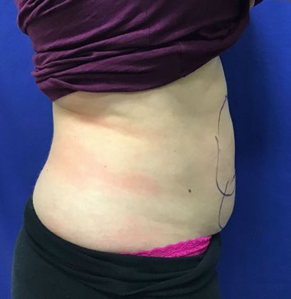 Body Coolsculpting: Case 7 (31213) - Before