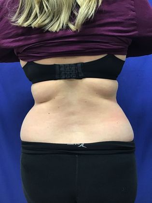 Body Coolsculpting: Case 7 (31213) - Before