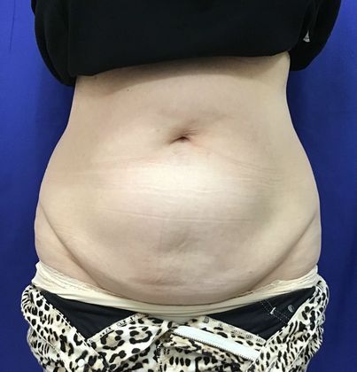 Body Coolsculpting Case 8 (21333) - After