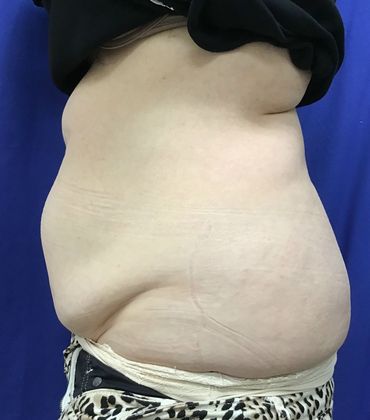 Body Coolsculpting: Case 8 (21333) - After
