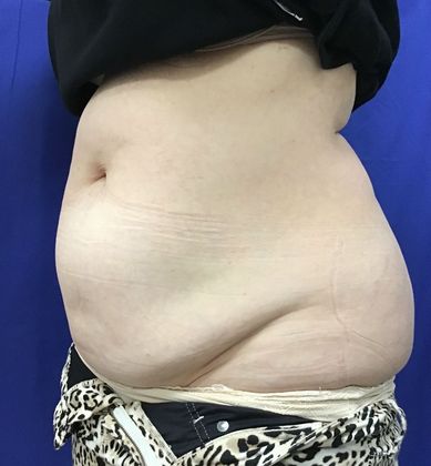 Body Coolsculpting: Case 8 (21333) - After