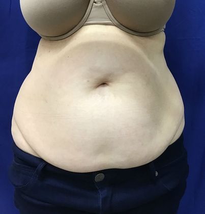 Body Coolsculpting Case 8 (21333) - Before