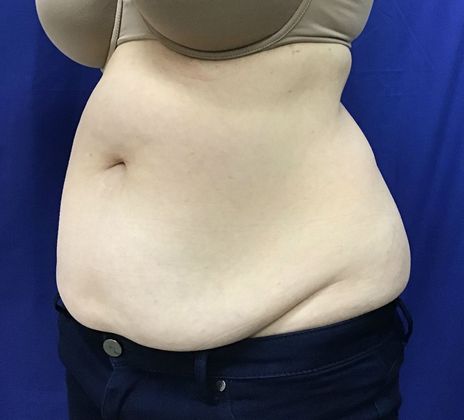 Body Coolsculpting: Case 8 (21333) - Before