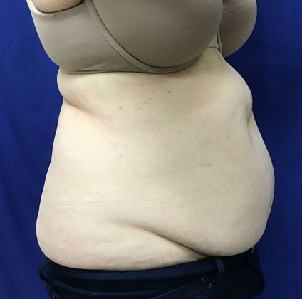 Body Coolsculpting: Case 8 (21333) - Before