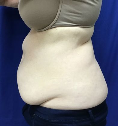 Body Coolsculpting: Case 8 (21333) - Before