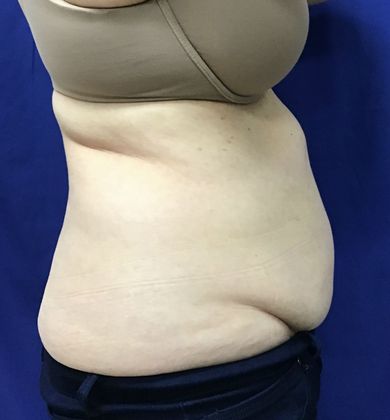 Body Coolsculpting: Case 8 (21333) - Before