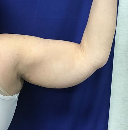 Body Coolsculpting Case 9 (30833) - Before