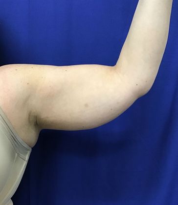 Body Coolsculpting Case 9 (30833) - After