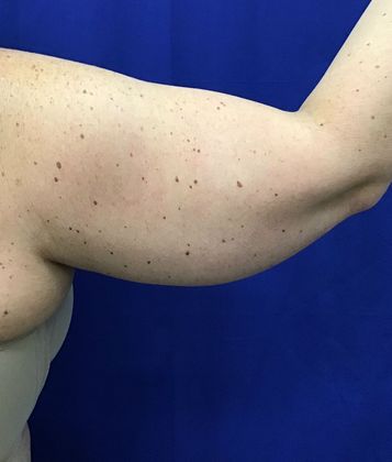Body Coolsculpting: Case 9 (30833) - After