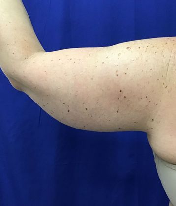 Body Coolsculpting: Case 9 (30833) - After