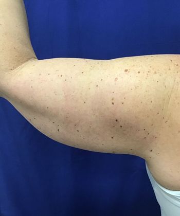 Body Coolsculpting: Case 9 (30833) - Before