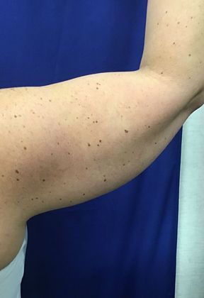 Body Coolsculpting: Case 9 (30833) - Before, right, back view