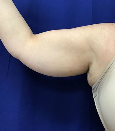 Body Coolsculpting: Case 9 (30833) - After