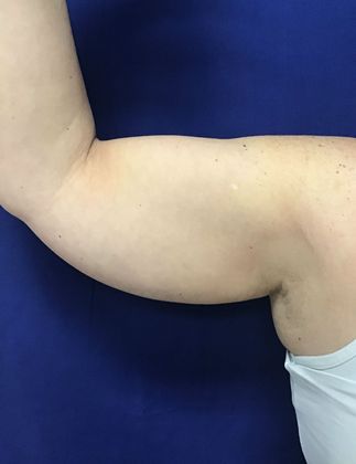 Body Coolsculpting: Case 9 (30833) - Before, right, front view