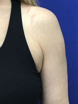 Body Coolsculpting: Case 10 (21903) - Before