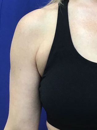 Body Coolsculpting Case 10 (21903) - Before