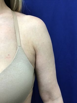 Body Coolsculpting: Case 10 (21903) - After