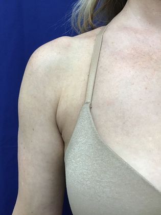 Body Coolsculpting Case 10 (21903) - After