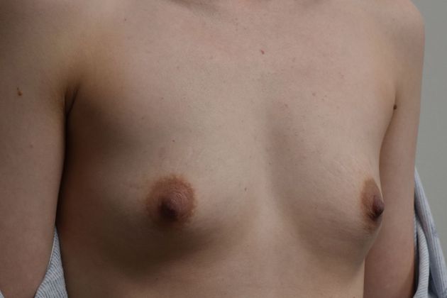 Breast Augmentation: Case 636 - Before